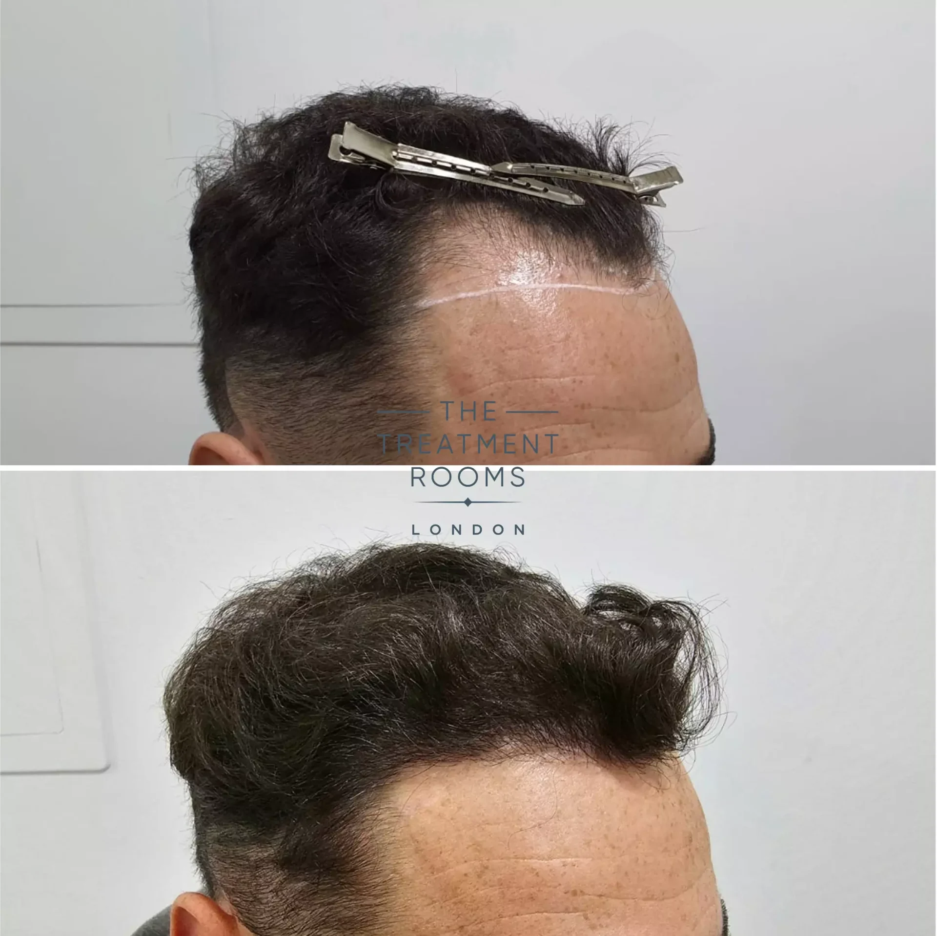 Hairline hair transplant 1303 grafts before and after
