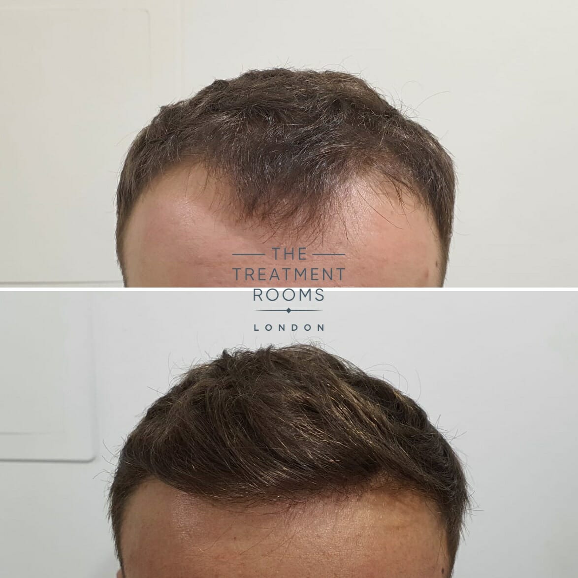 Hairline hair transplant before and after