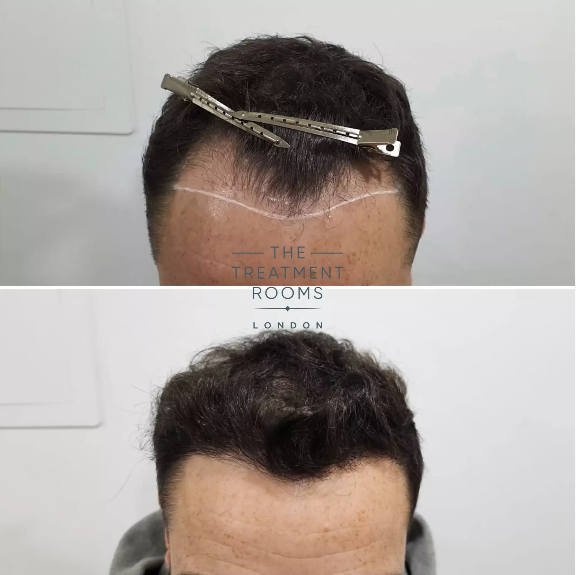 Hairline hair transplant london 1303 grafts before and after