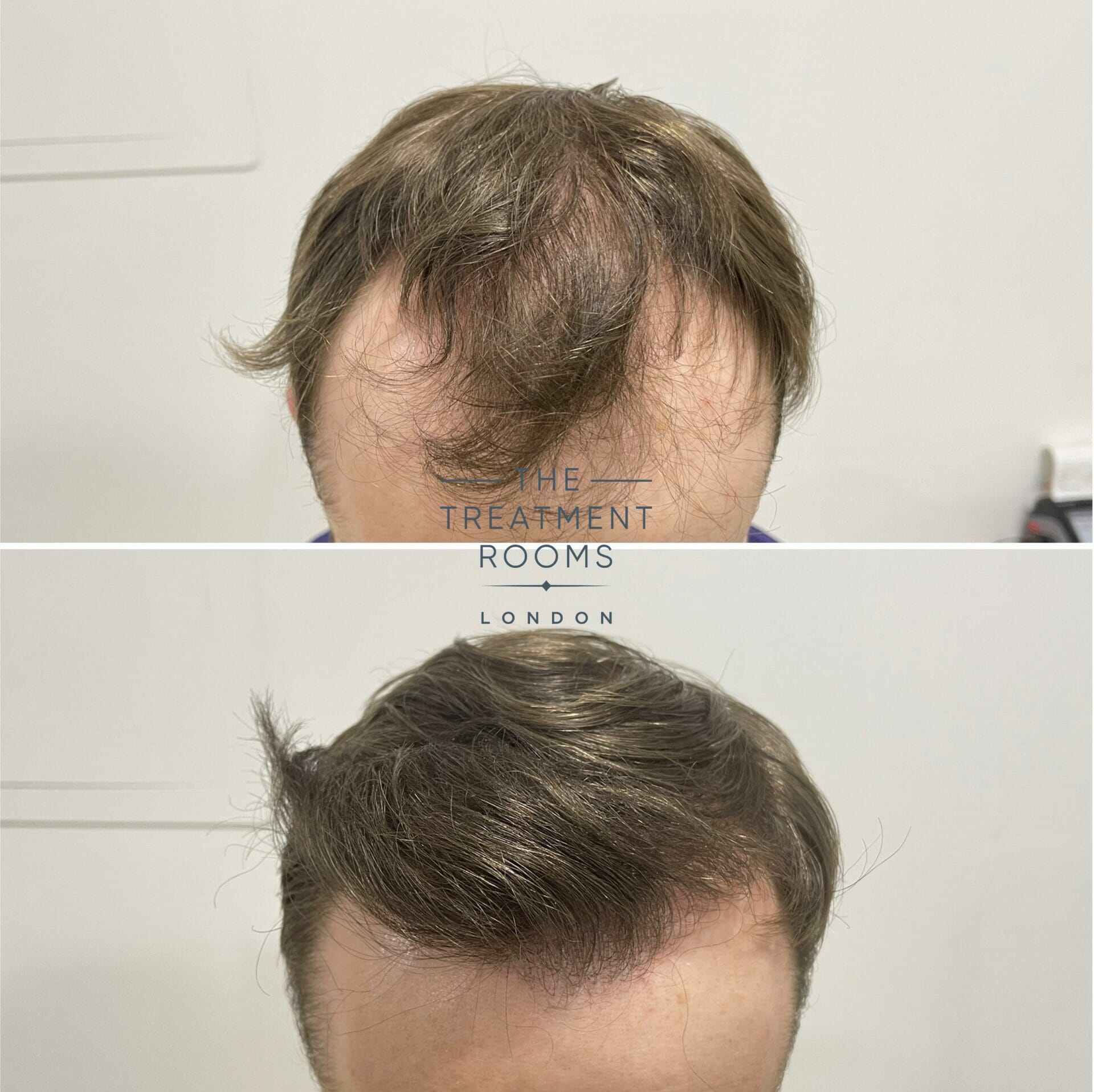 Hairline hair transplant result