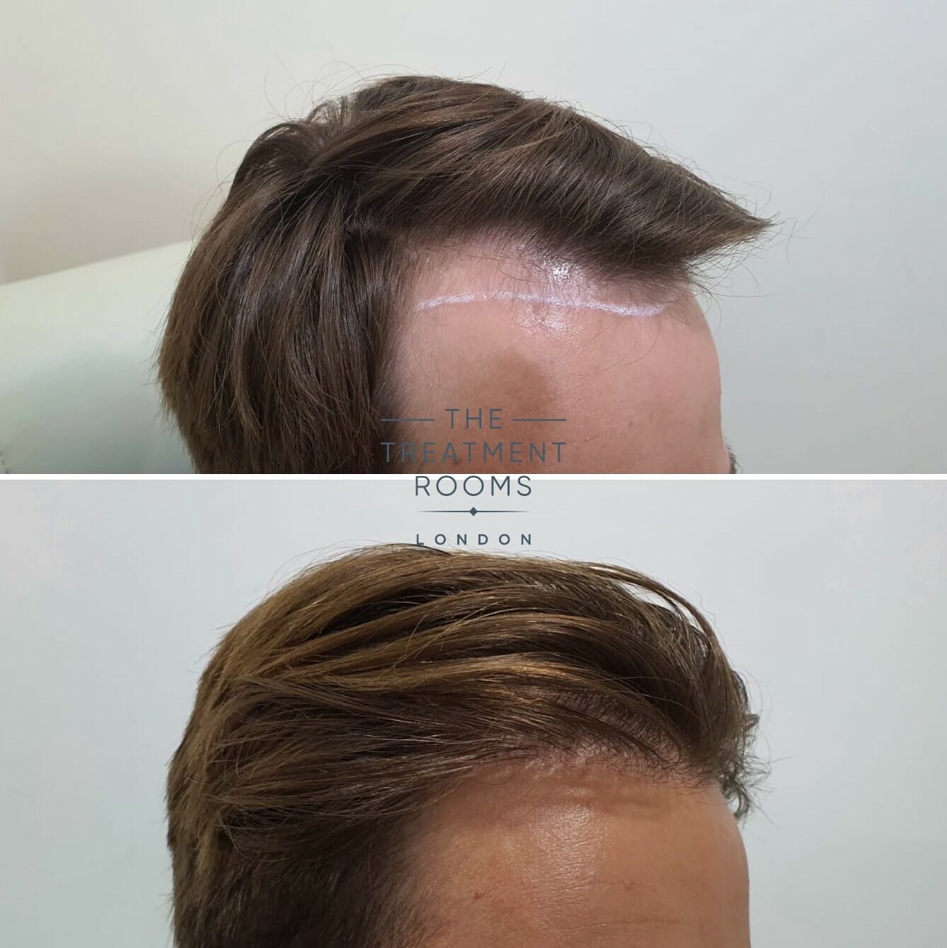 Hairline hair transplant result 1491 grafts