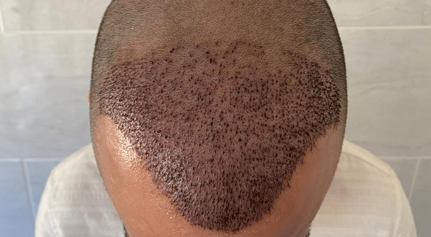 Can You Wear A Hat After A Hair Transplant And How Soon After The Procedure