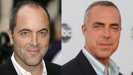 James-Nesbitt-Hair-Transplant