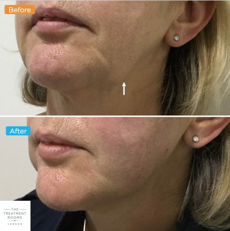 Jowl Thread Lift What You Need To Know The Treatment Rooms London
