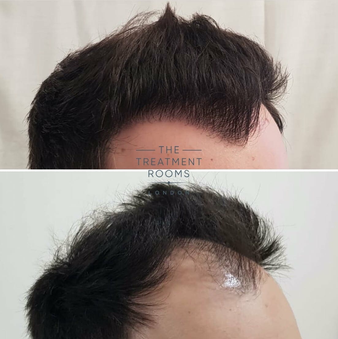 Large Right FUE hair transplant london before and after Large Right FUE hair transplant London before and after