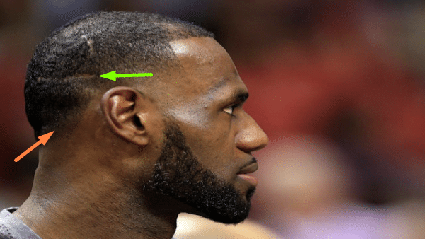Lebron James head with hair transplant scars on it