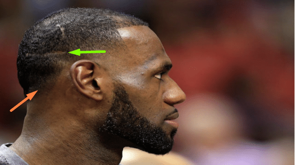 Lebron 4 Lebron James head with hair transplant scars on it