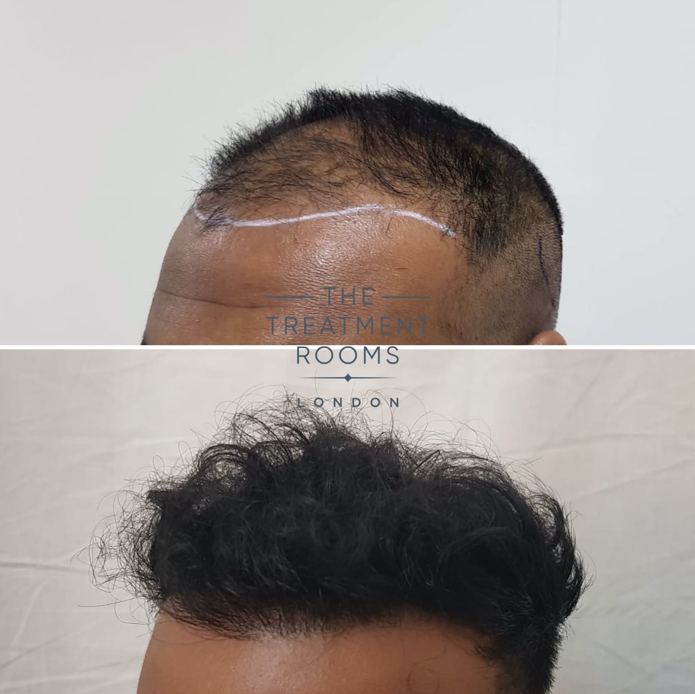 Left FUE hair transplant london