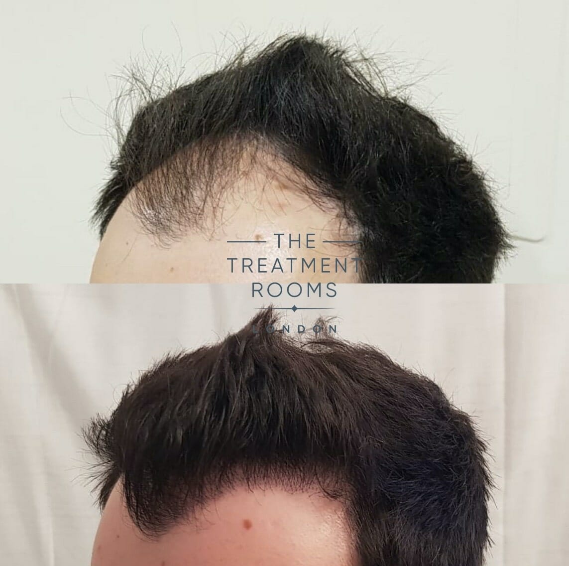 Left Hairline FUE Hair Transplant