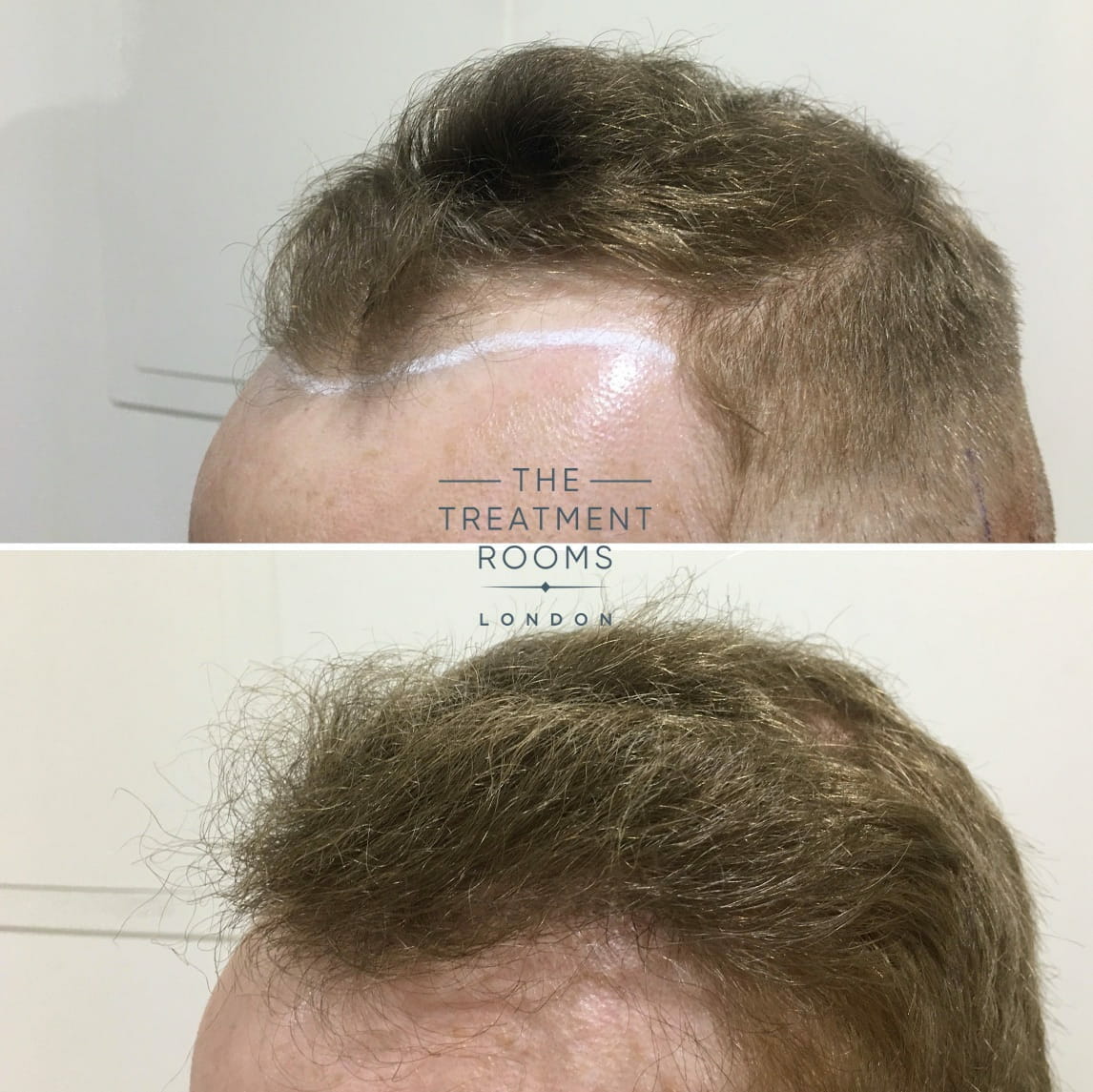 Left Temple with Hairline Hair Transplant Left Temple with Hairline Hair Transplant