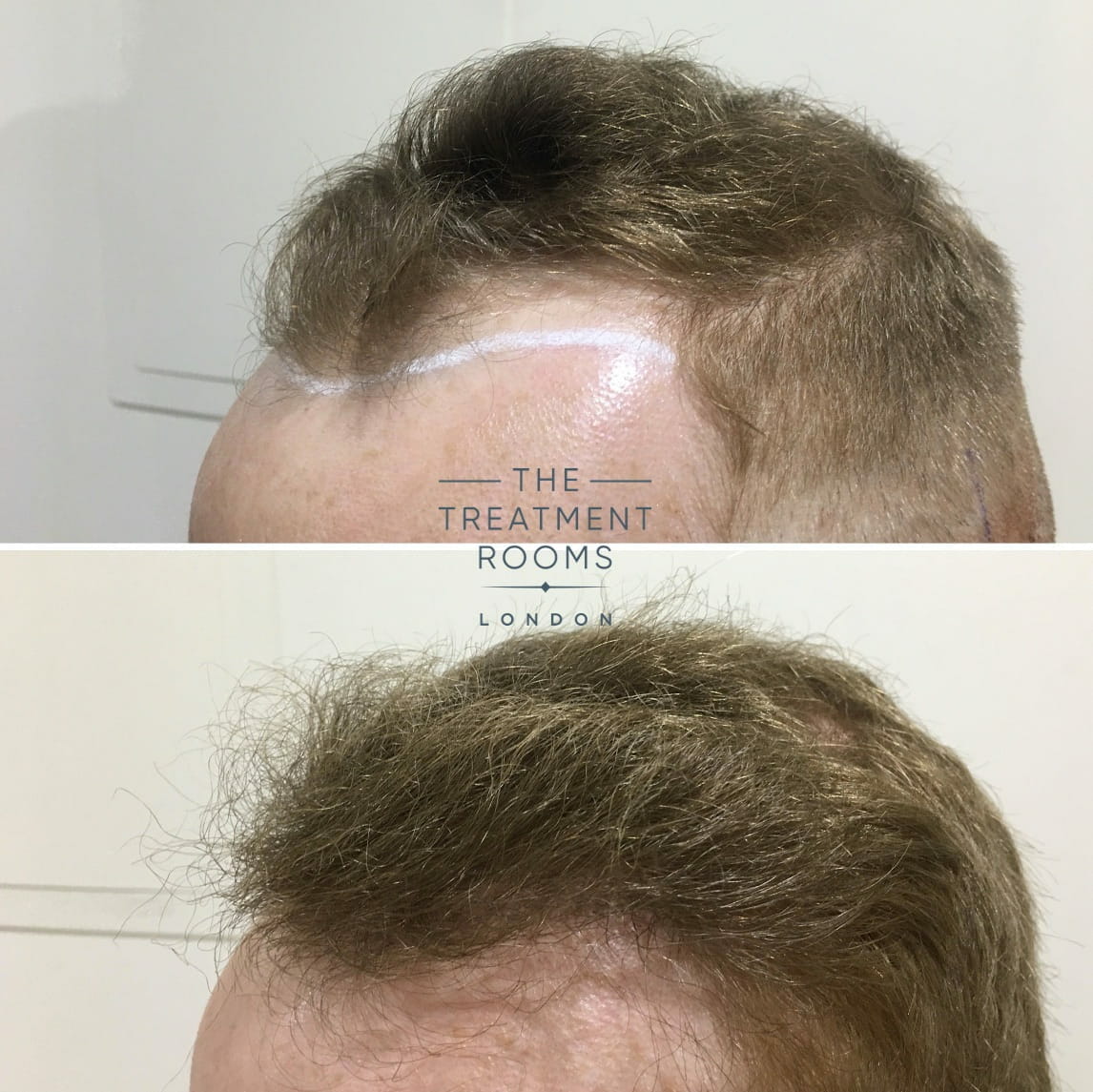 Left Temple with Hairline Hair Transplant