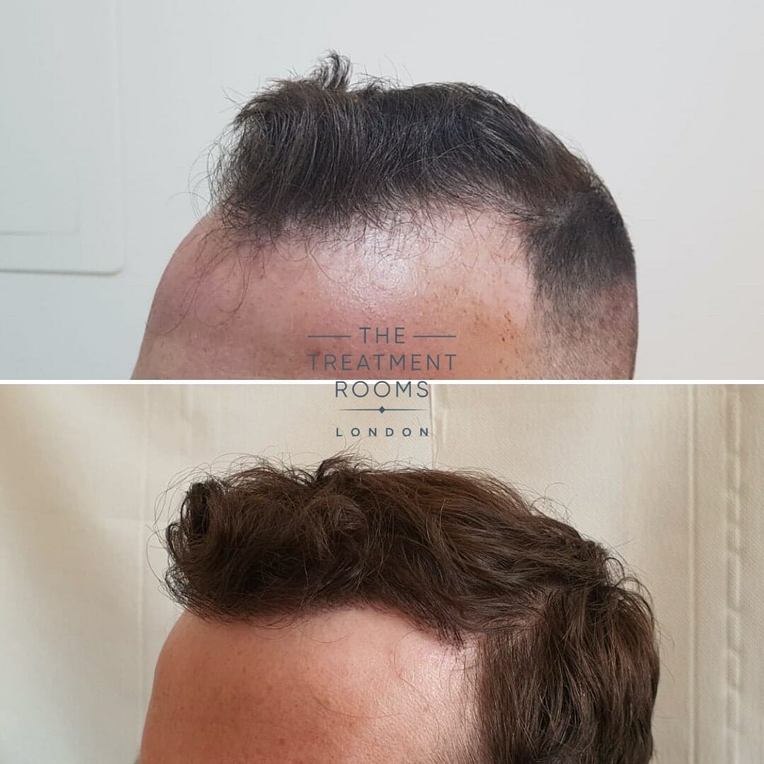 left hairline hair transplant london