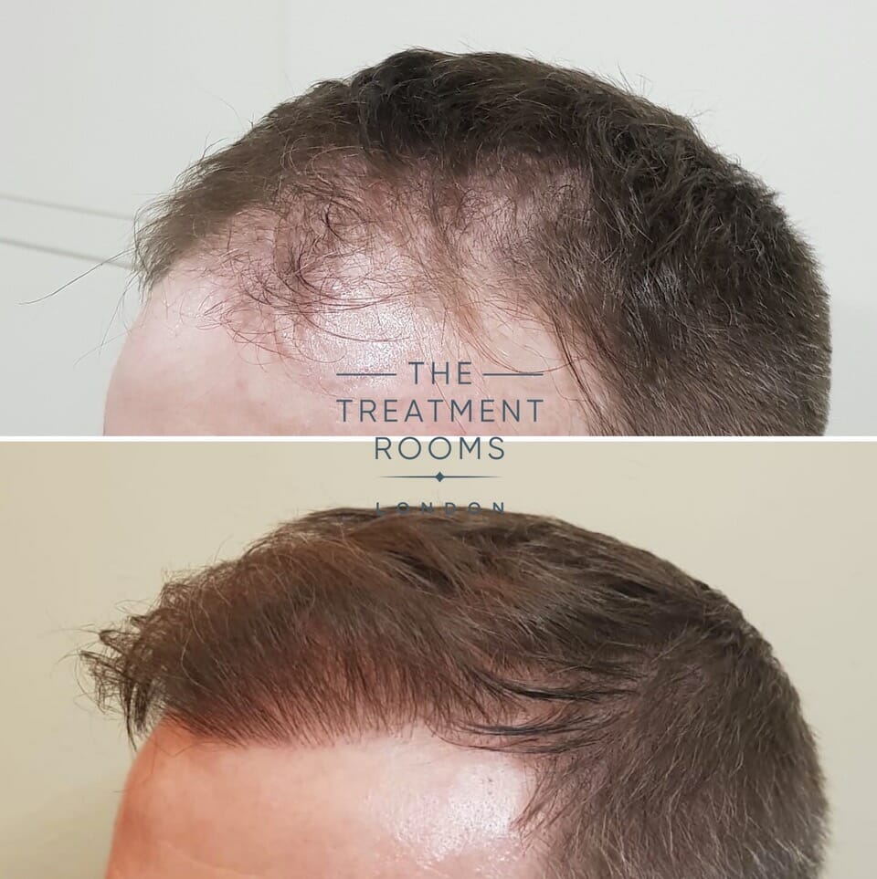 Hairline hair transplant london FUE