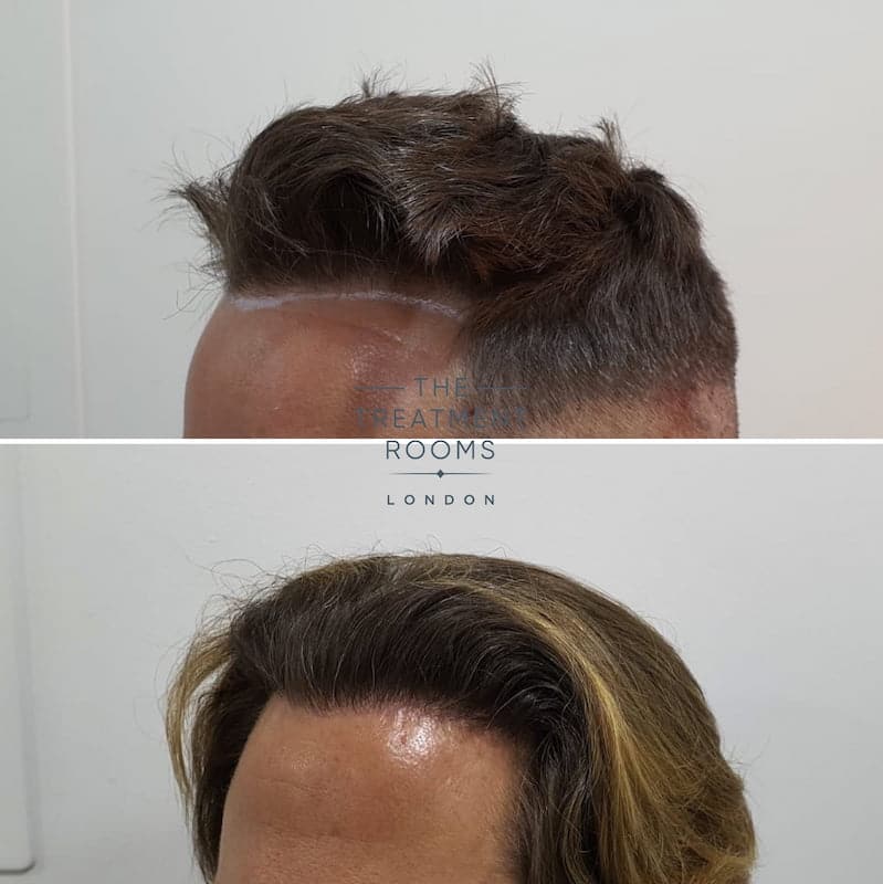 Left hairline DHI hair transplant before and after