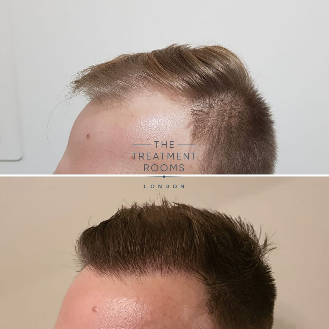 Left hairline and temple hair transplant