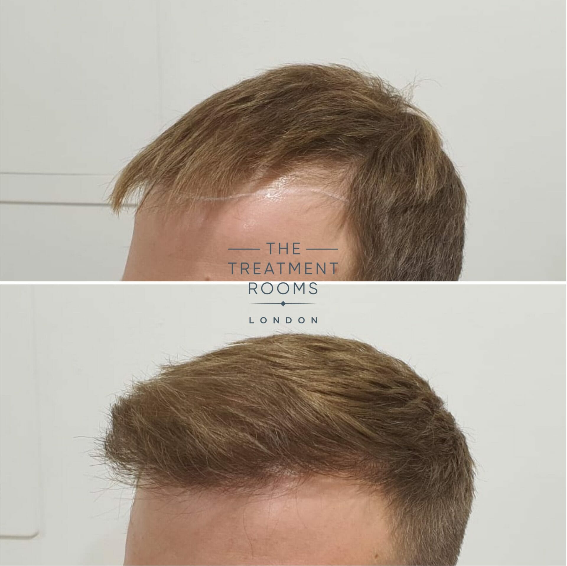 Left hairline before and after FUE hair transplant