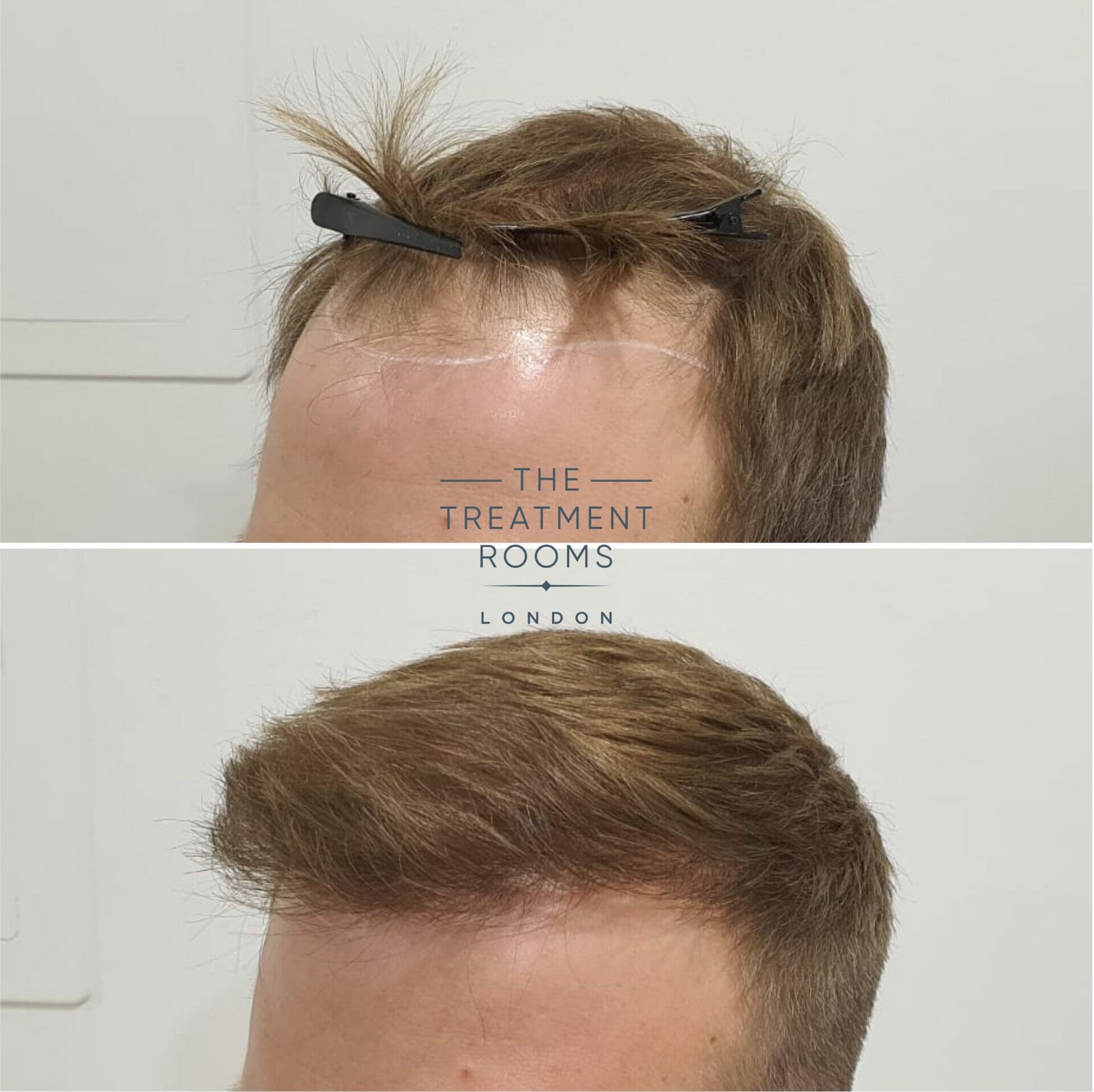 Left hairline before and after hair transplant