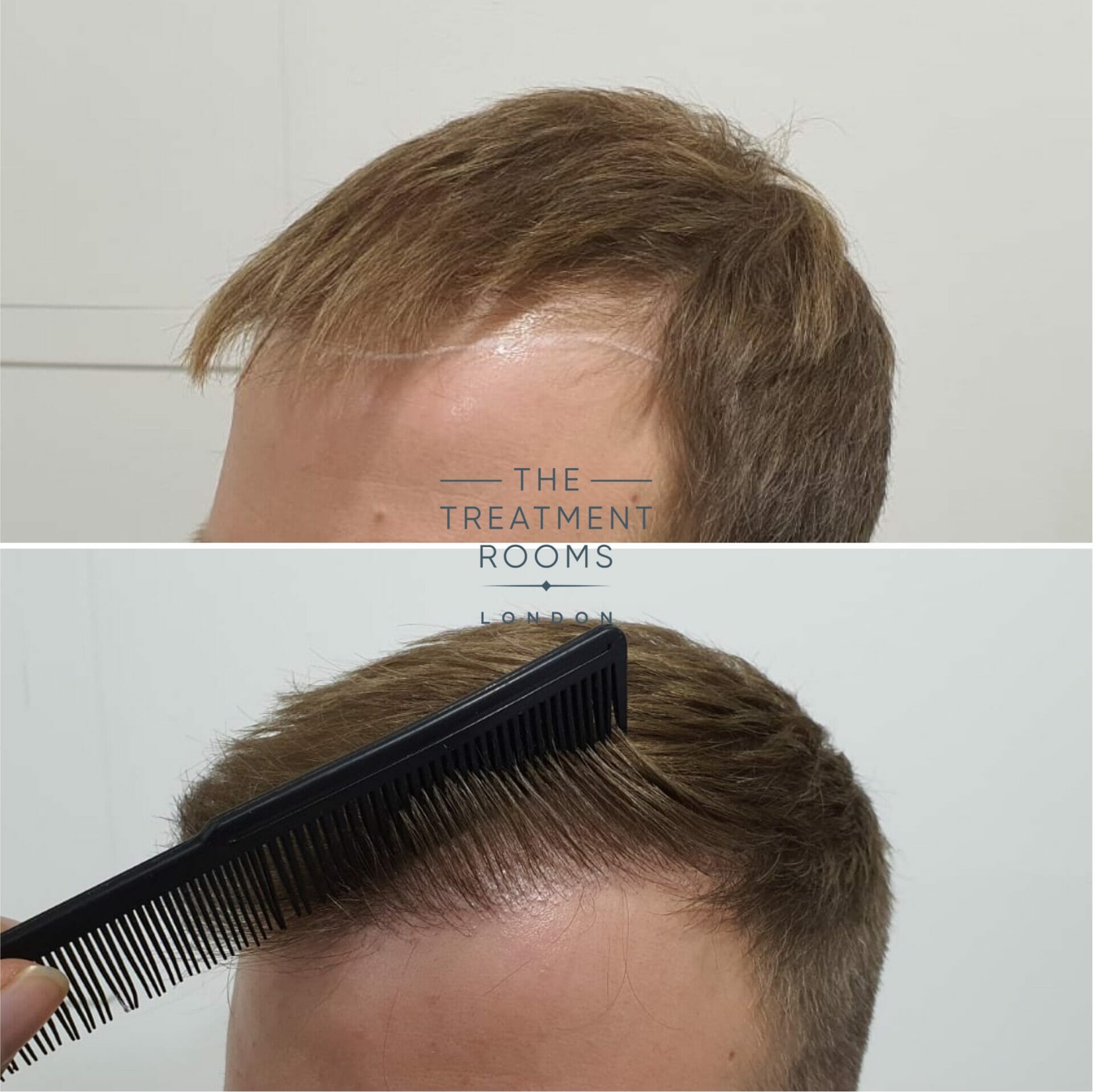 Left hairline closeup before and after FUE hair transplant