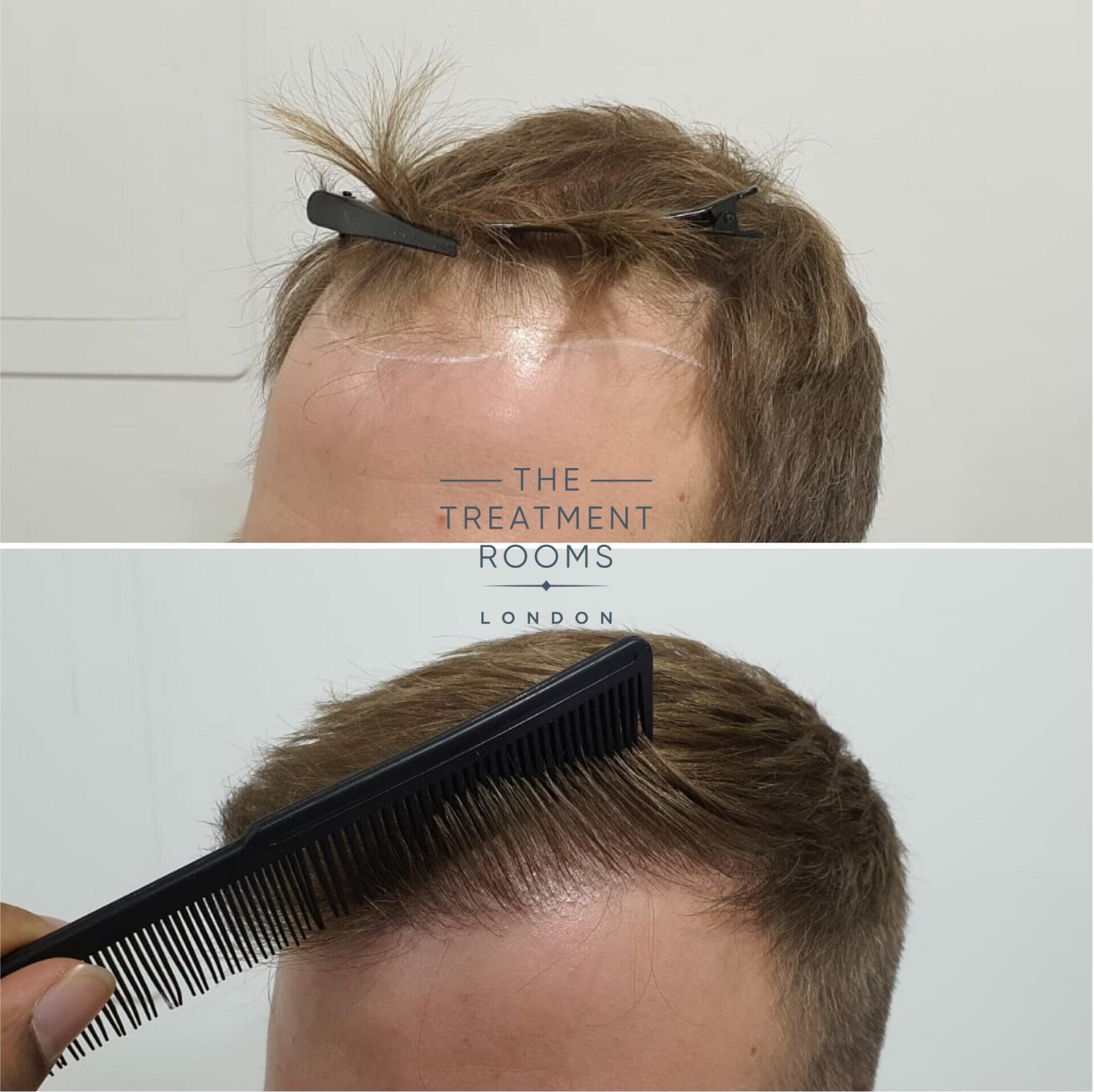 Left hairline closeup before and after hair transplant