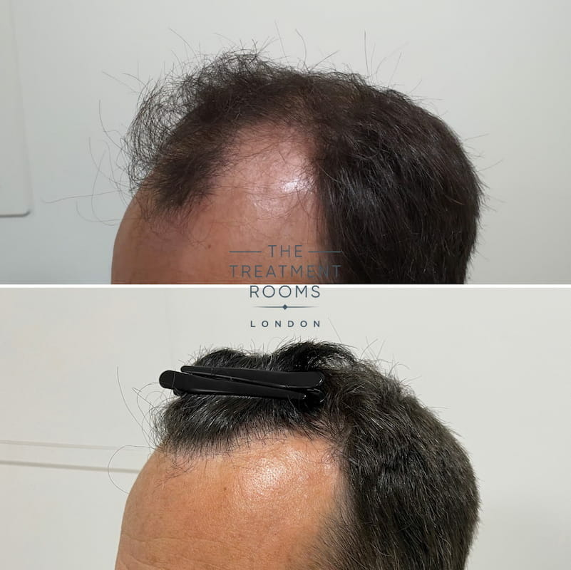 Left hairline hair transplant before and after