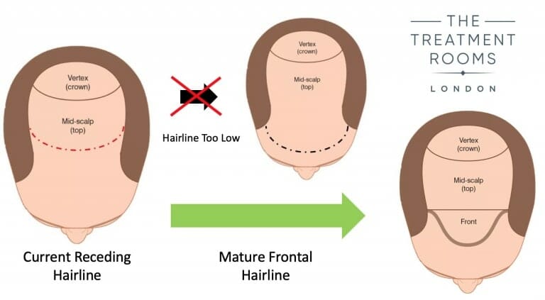 mature hairline