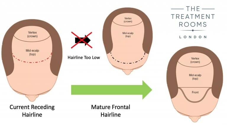 Hairline design for mature hairline hair transplant