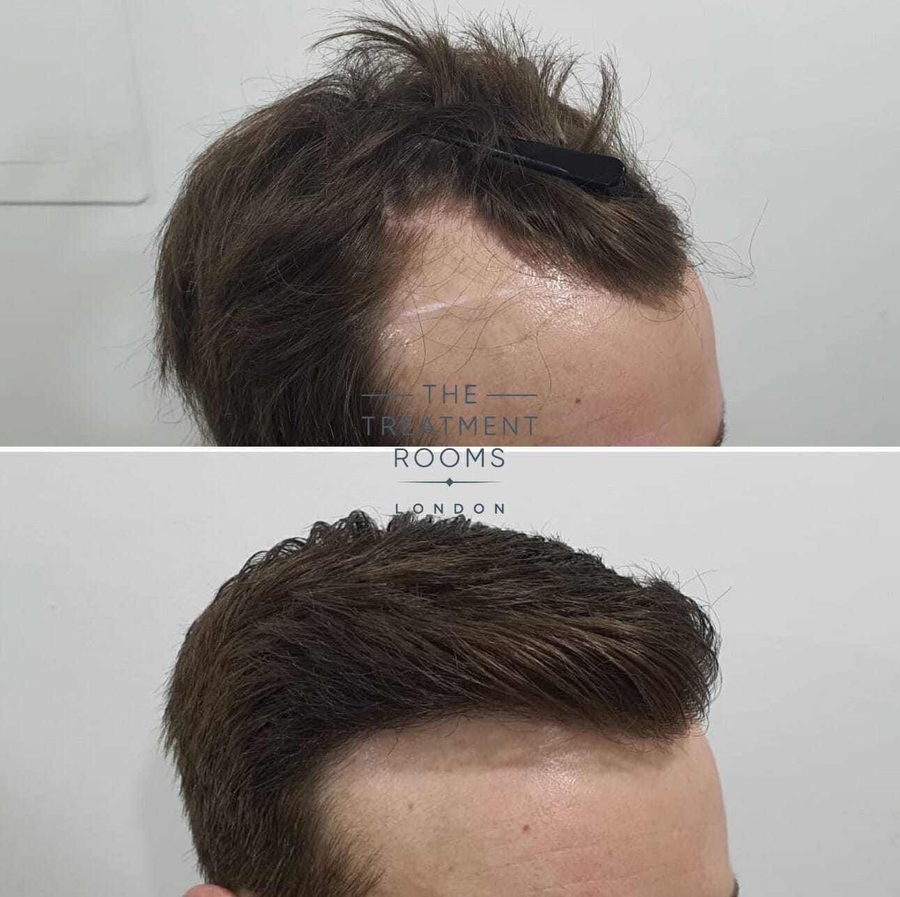 Mature Hairline vs Receding Hairline, What's The Difference? | Treatment  Rooms London