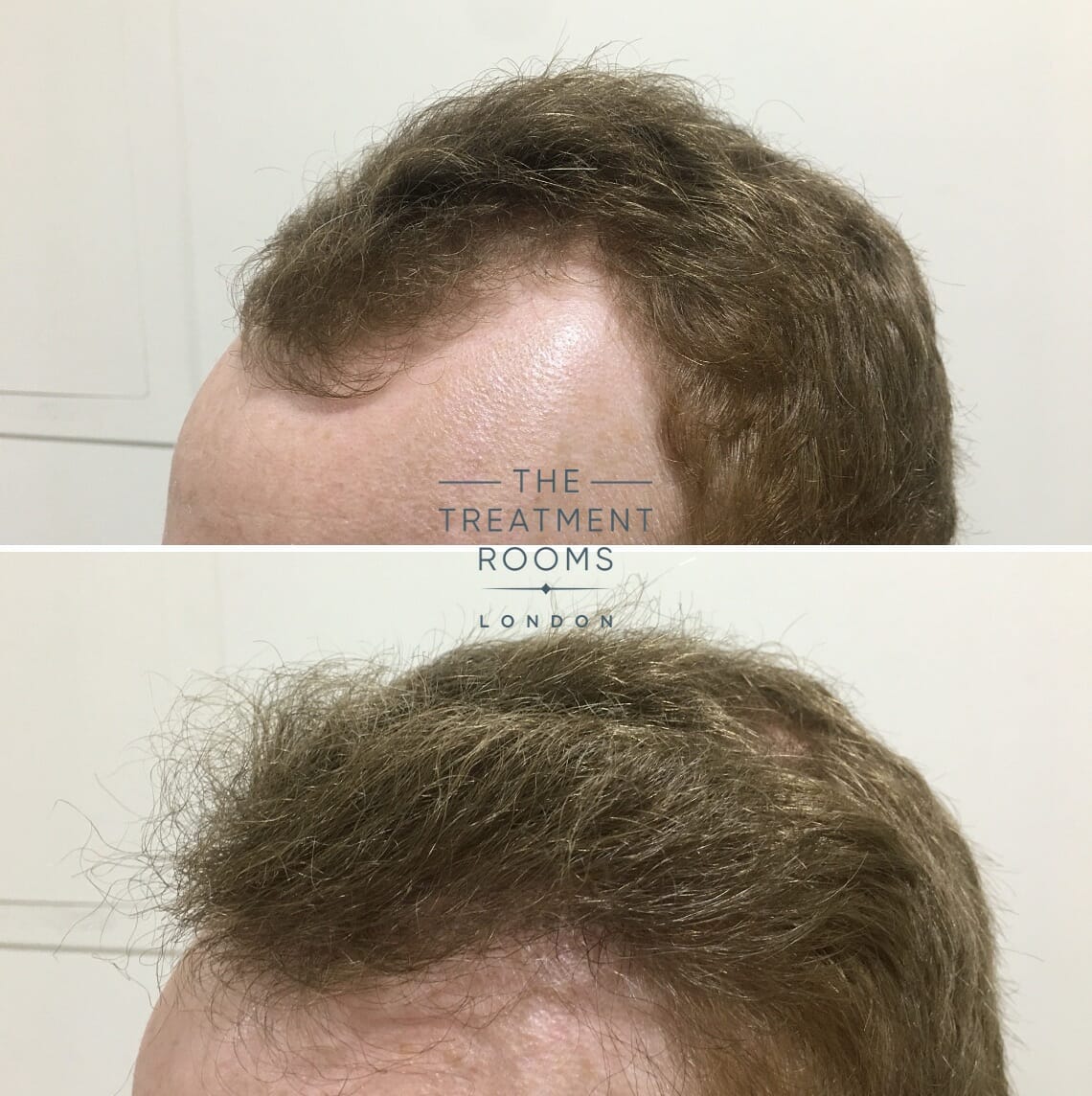 Minoxidil Hair Transplant