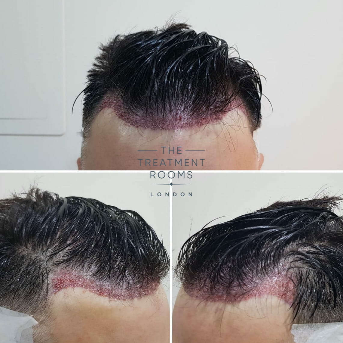 Norwood 2 hair loss before hair transplant