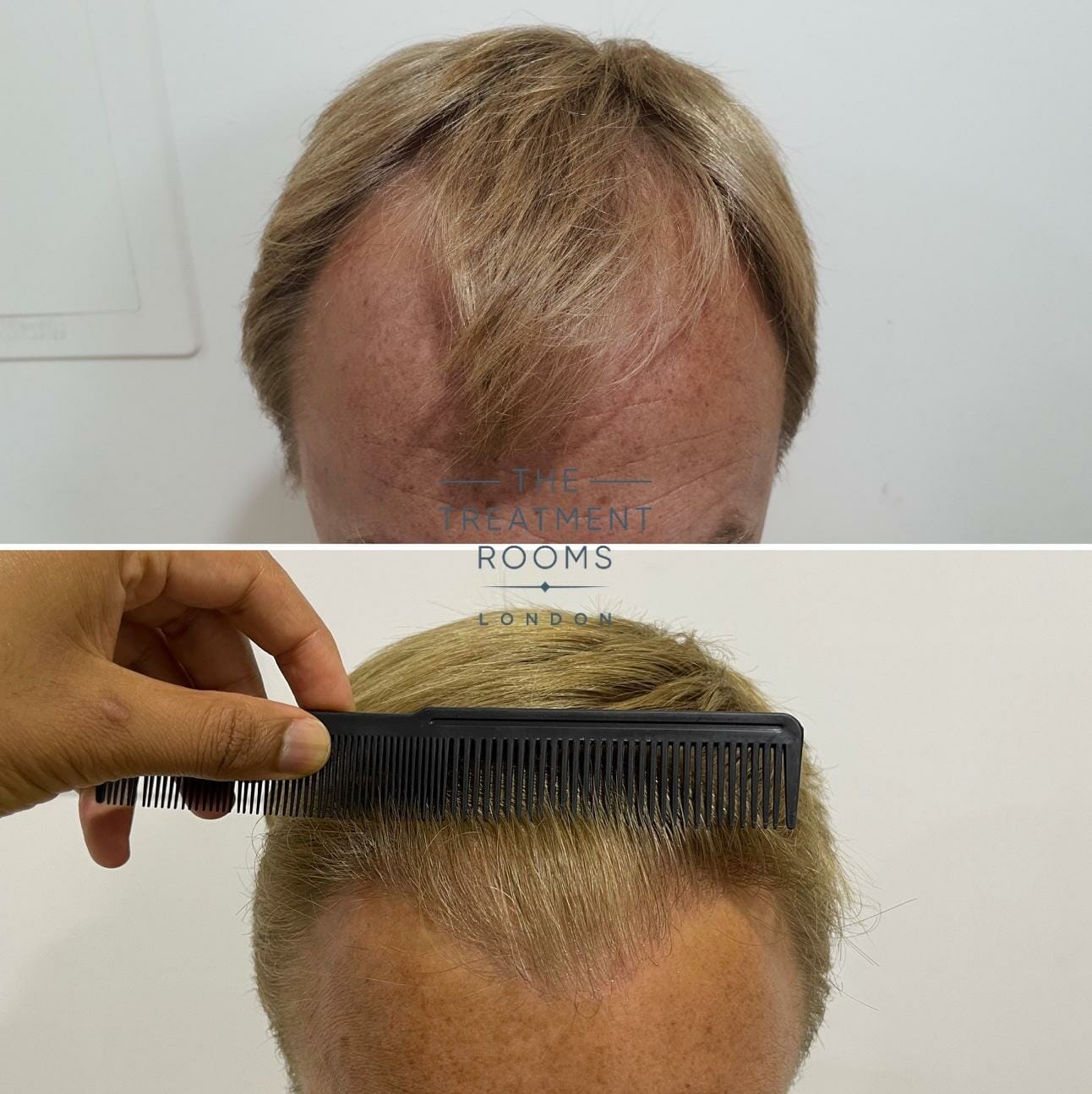 norwood 3 hair transplant before and after
