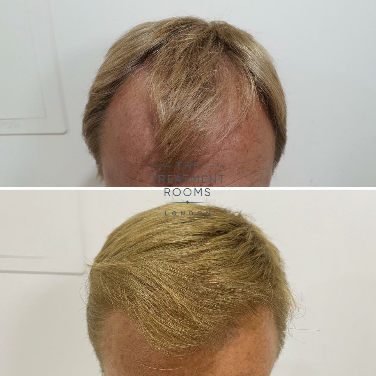 norwood 3 hair transplant result