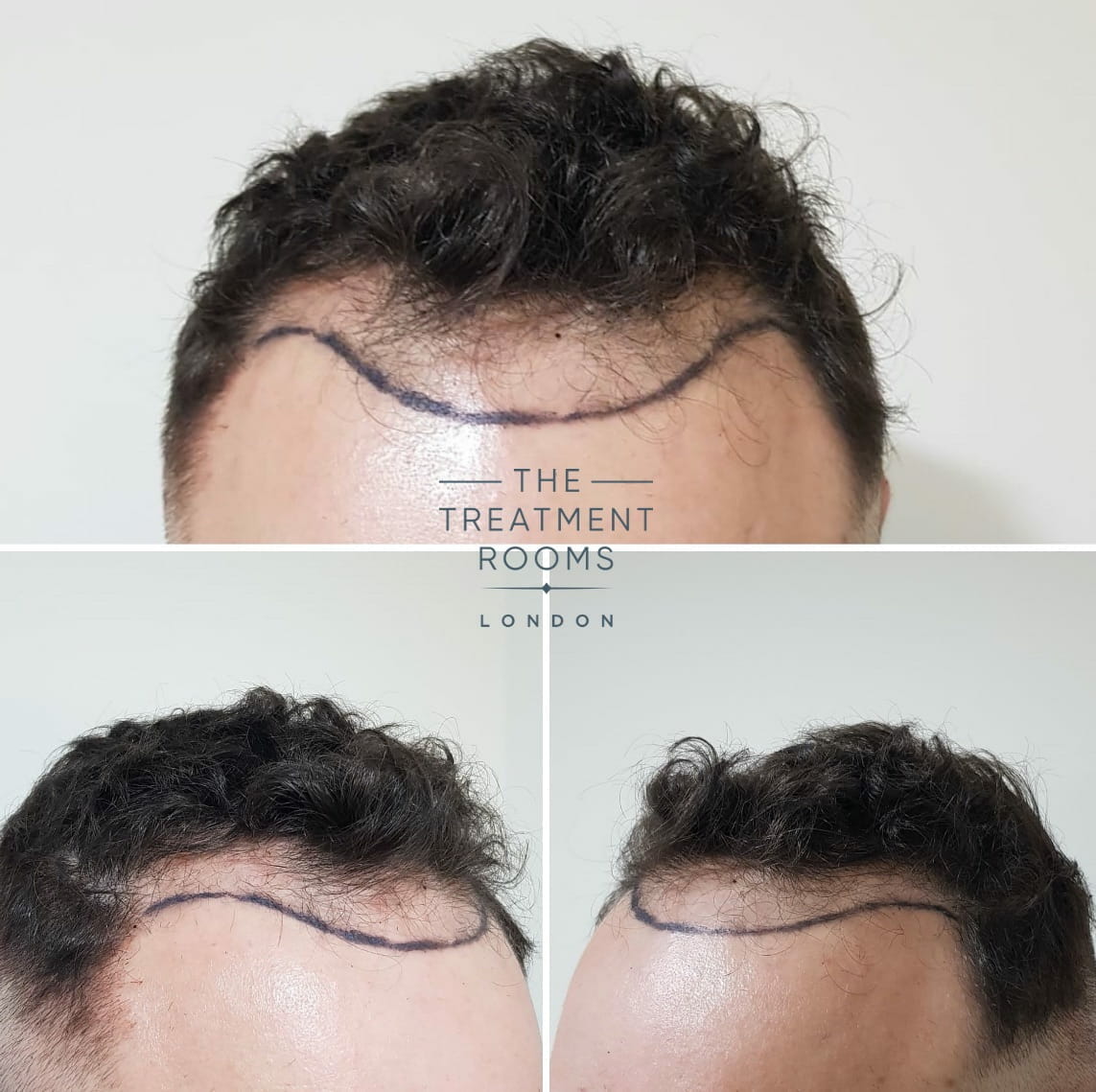 Norwood 3 hair loss before hair transplant