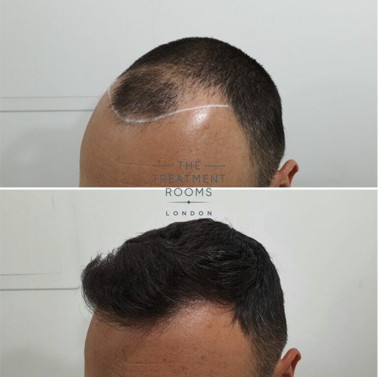 What You Need To Know About Shedding After A Hair Transplant