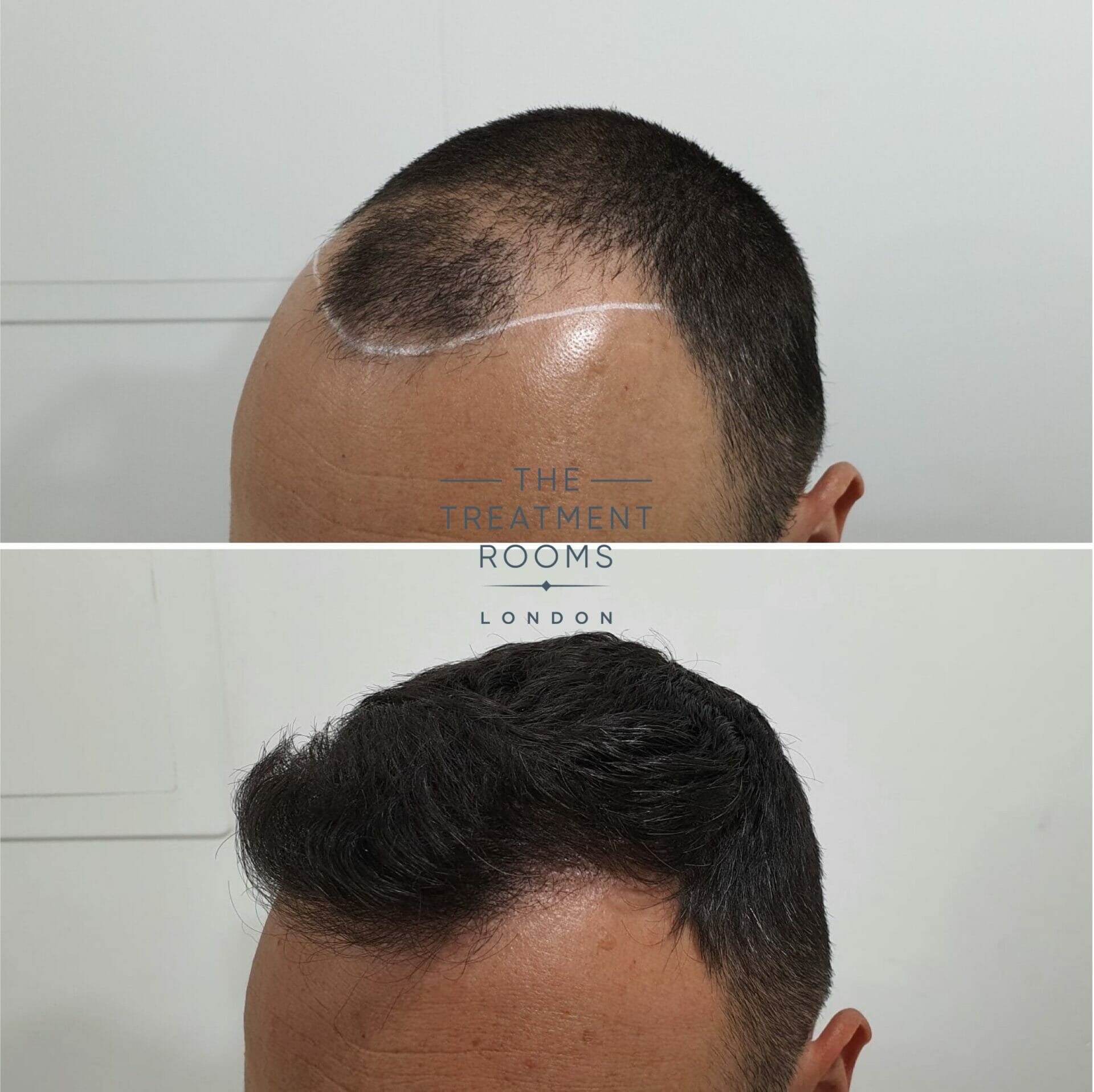 Norwood 4 FUE hair transplant before and after 1498 grafts