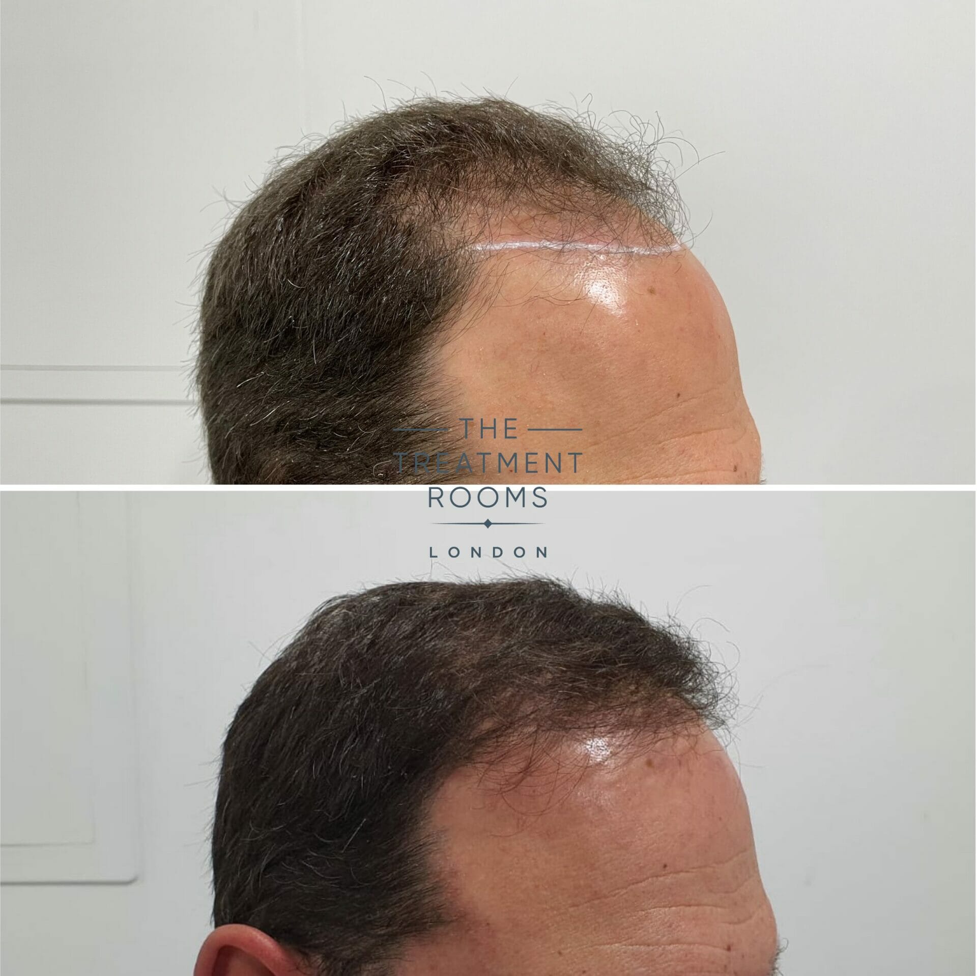 Norwood 4 FUE hair transplant before and after 1930 grafts