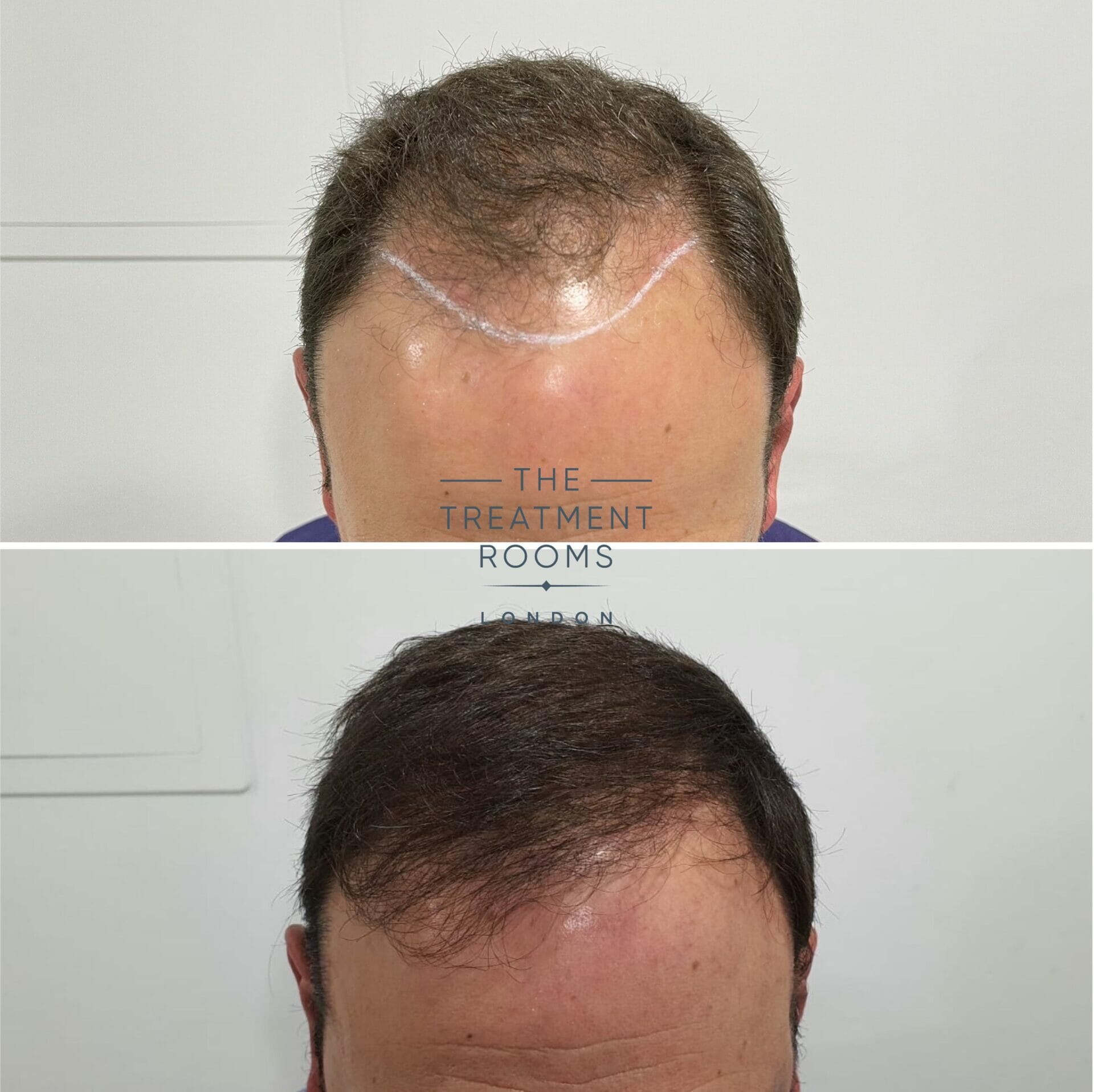 Norwood 4 FUE hair transplant result