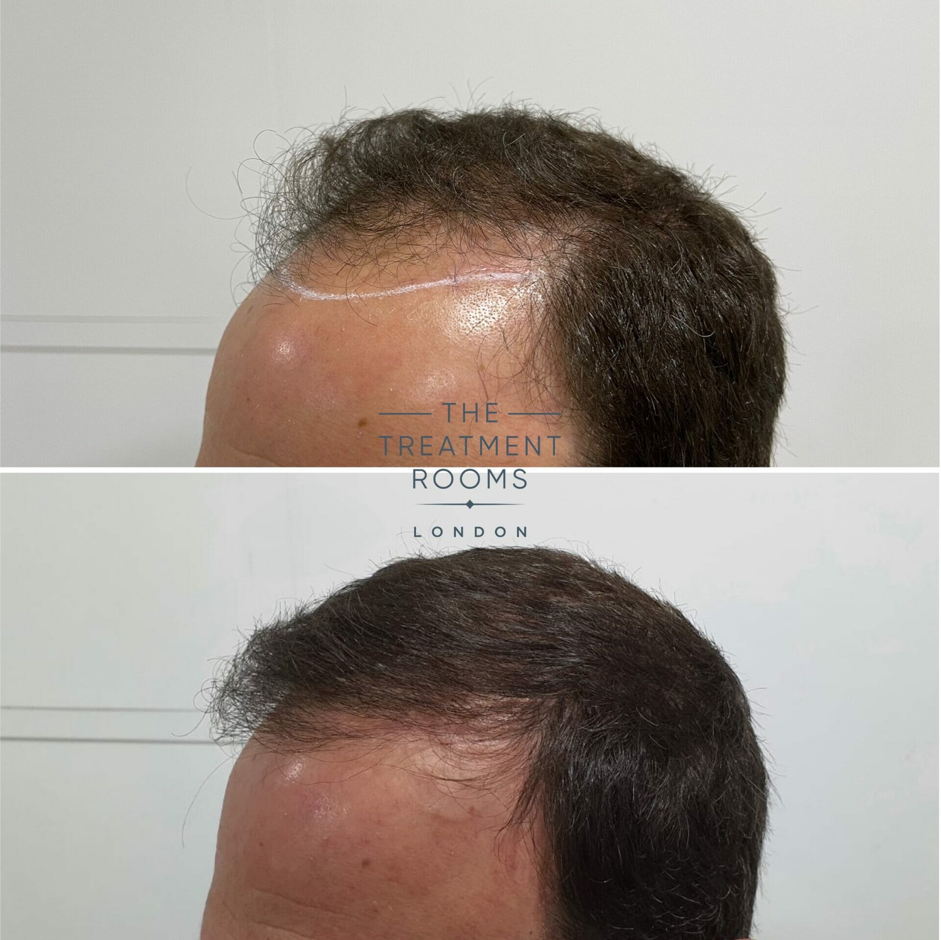 Norwood 4 FUE hair transplant result 1930 grafts