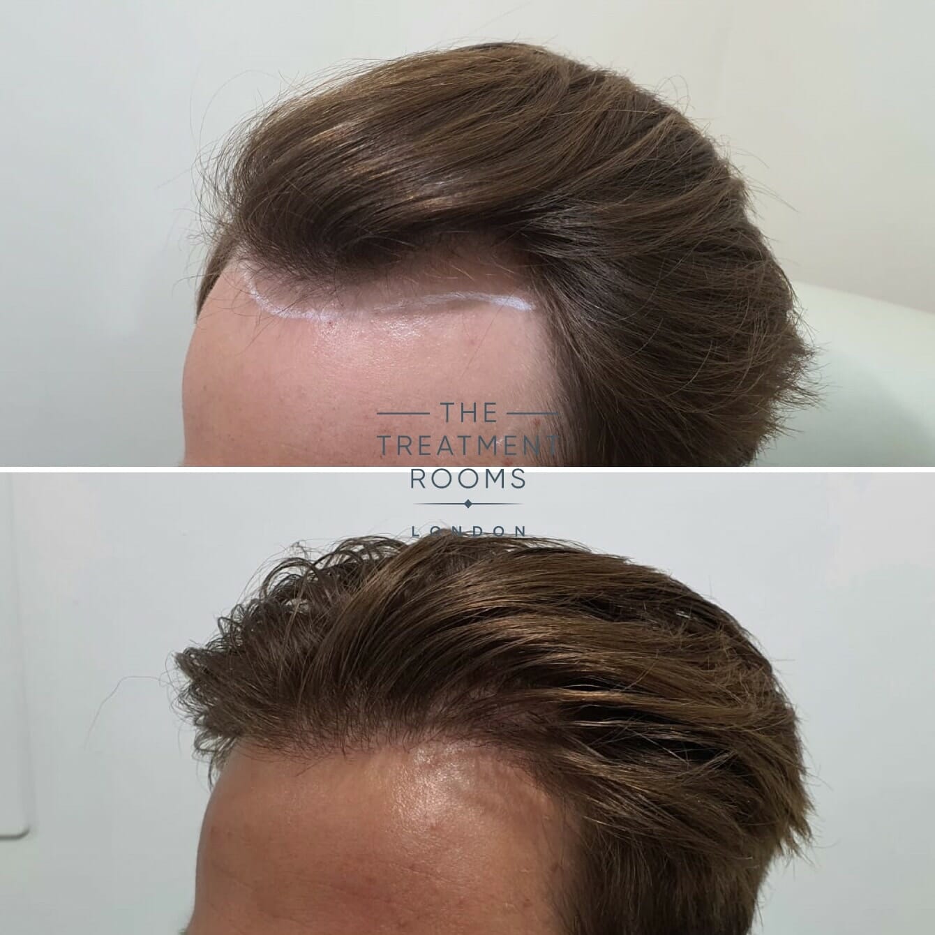 Everything You Need To Know About Hairline Transplants | Treatment Rooms  London