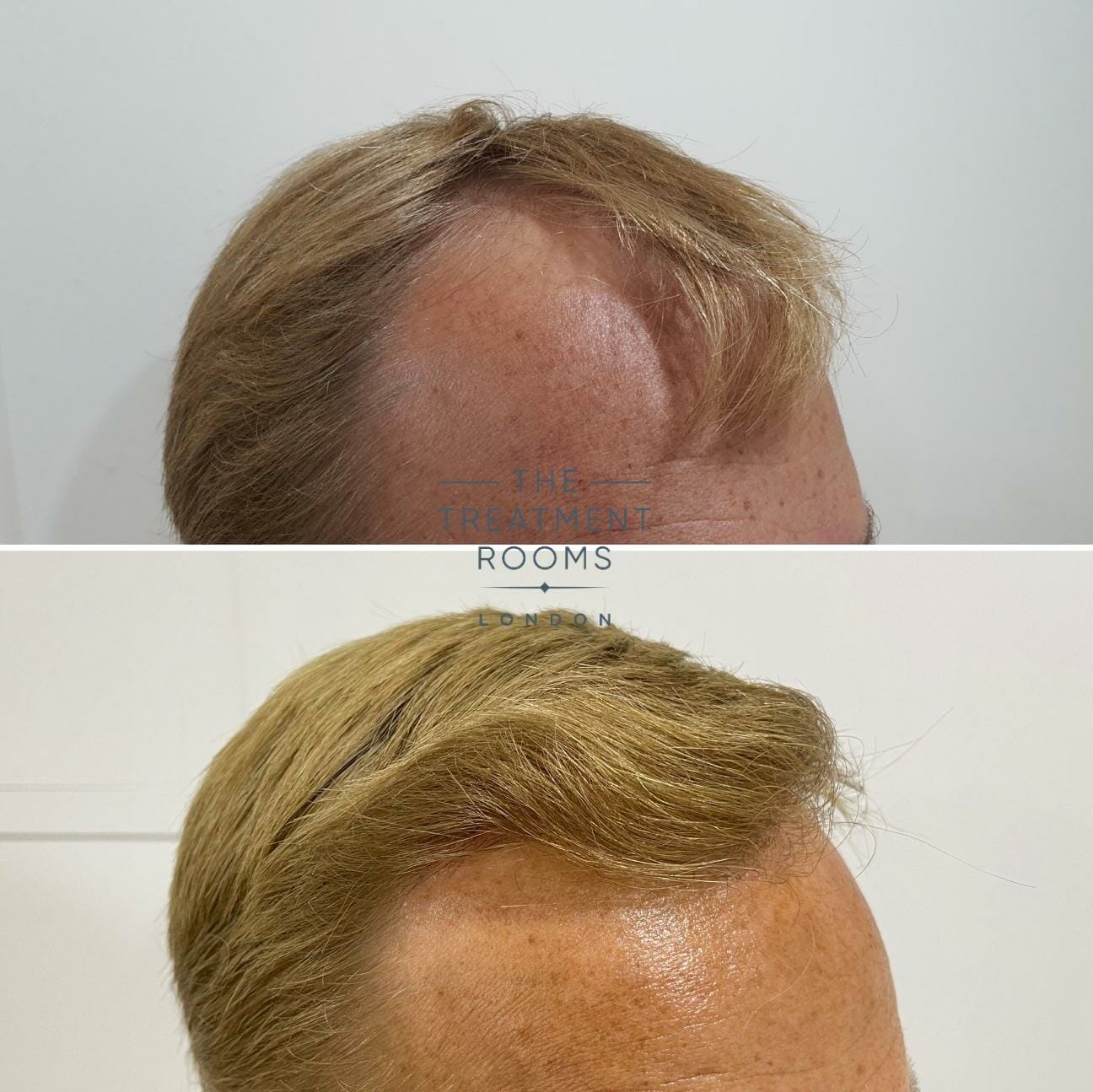 norwood 3 hair transplant london