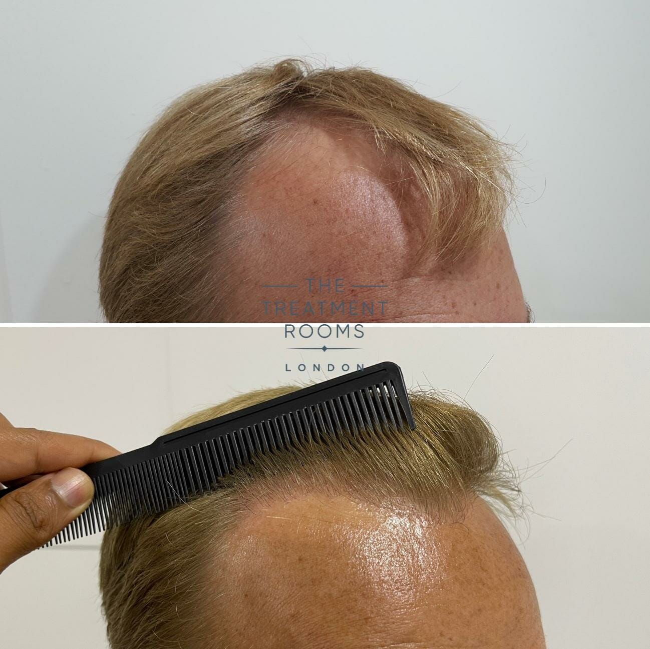 norwood 3 hair transplant london result