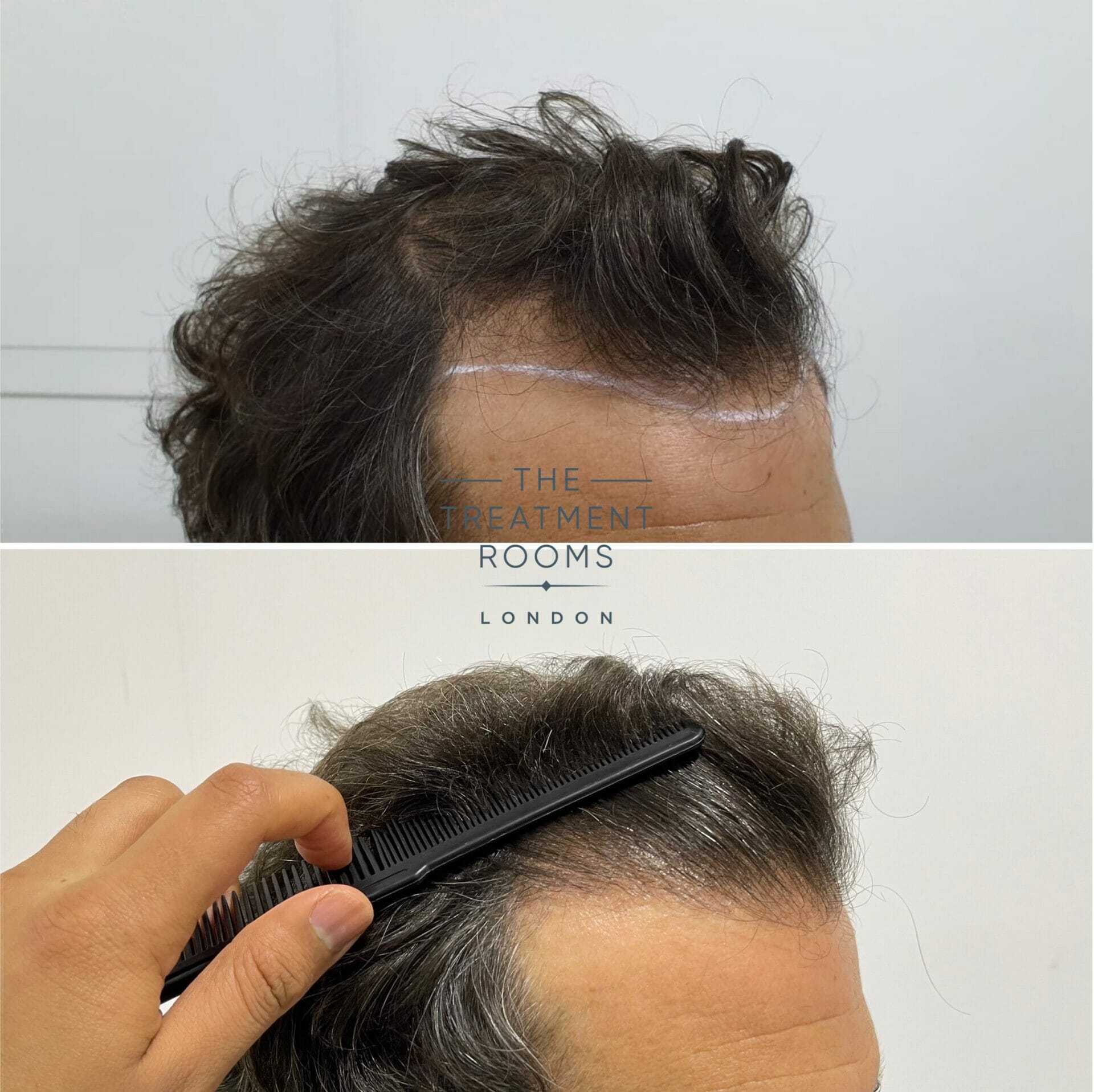 Receding hairline FUE hair transplant