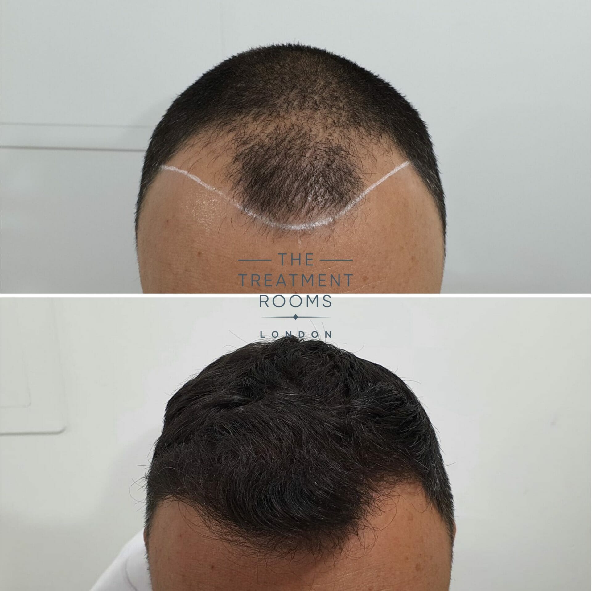 Receding hairline FUE hair transplant before and after 1498 grafts