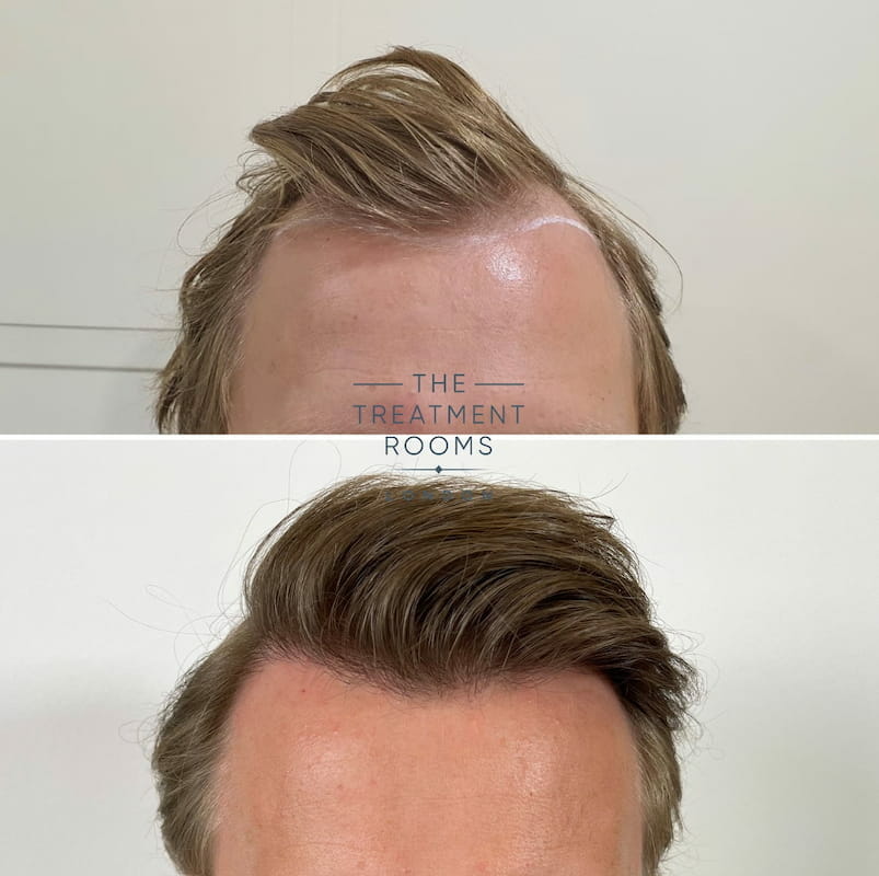 Receding hairline FUE hair transplant