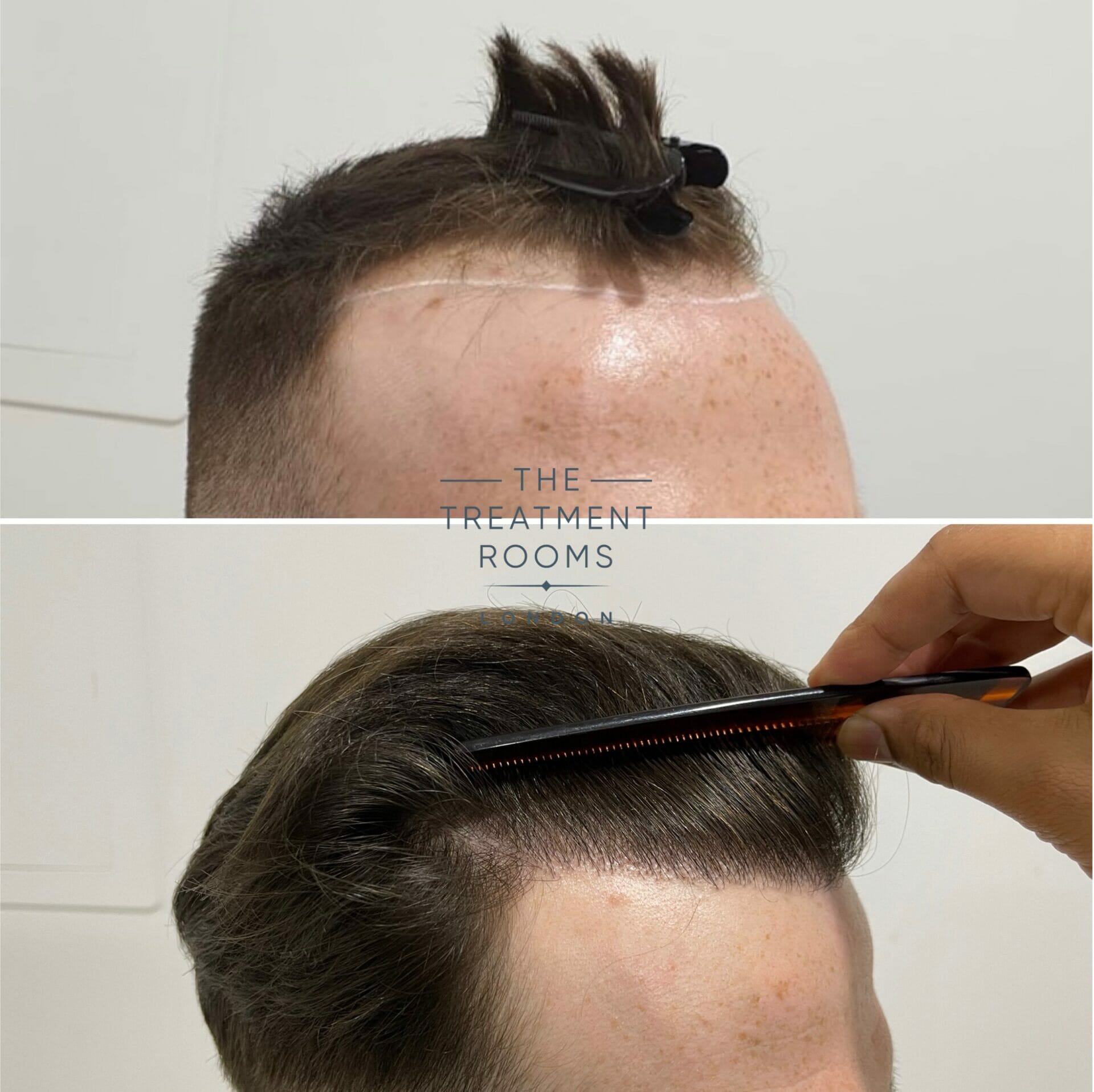 Receding hairline FUE surgery
