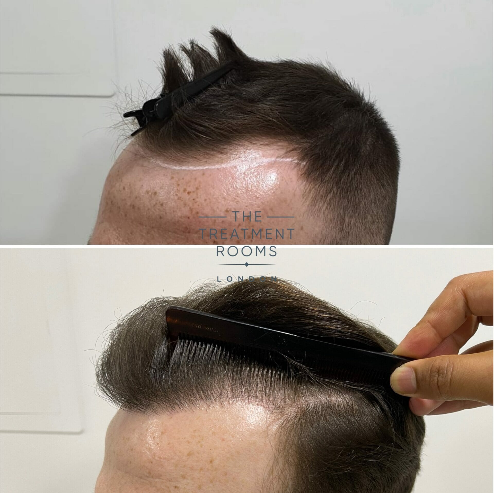 Receding hairline hair transplant