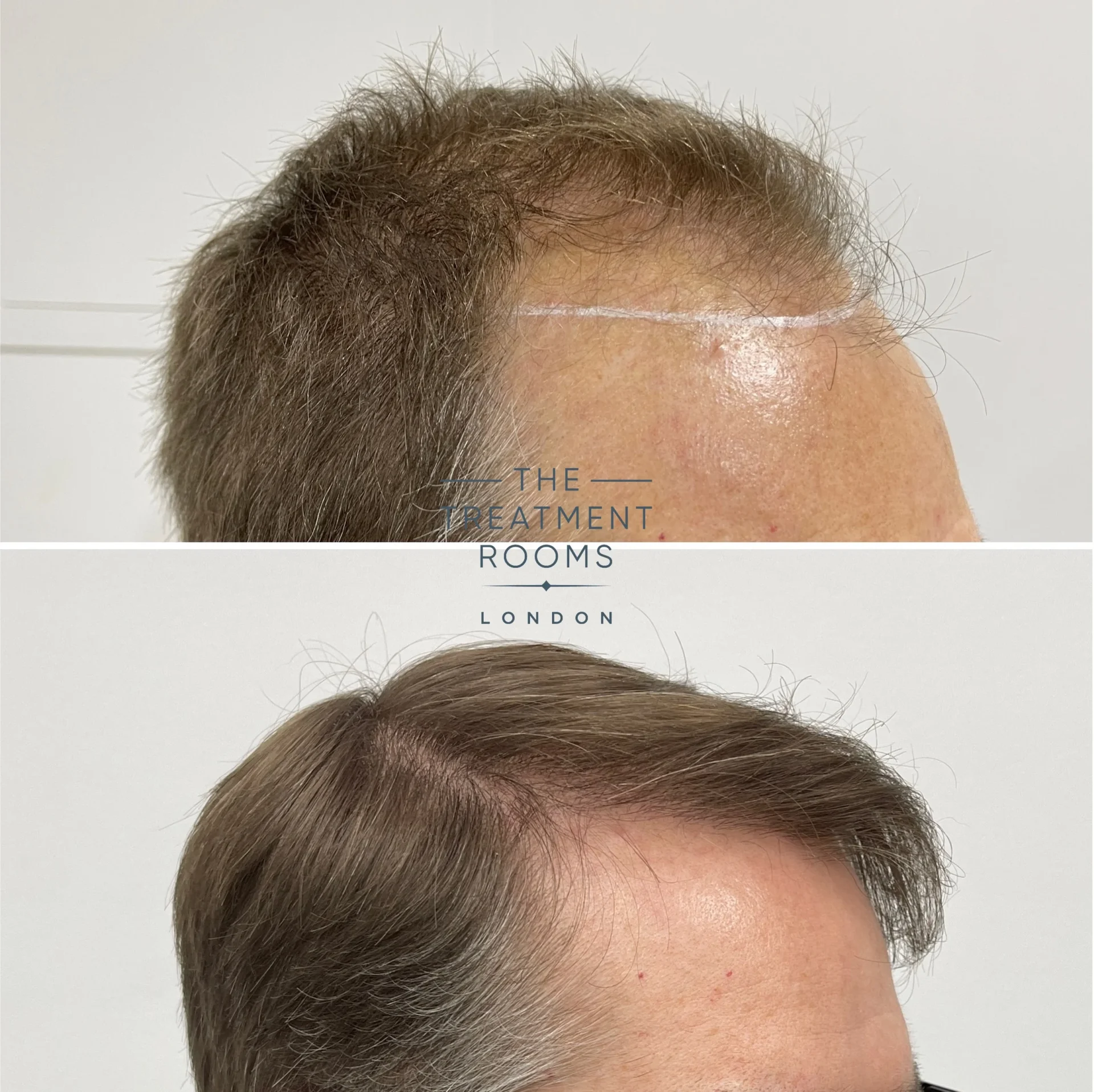 Receding hairline hair transplant 1839 grafts before and after