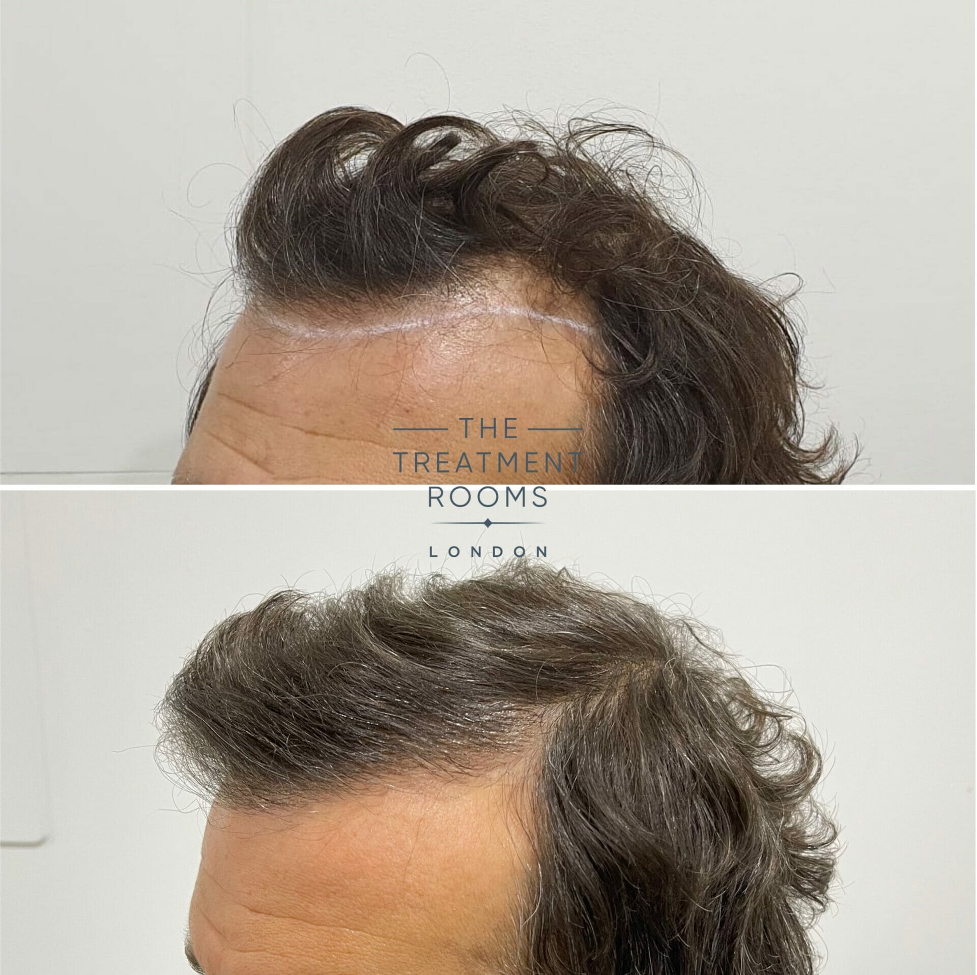 Receding hairline hair transplant