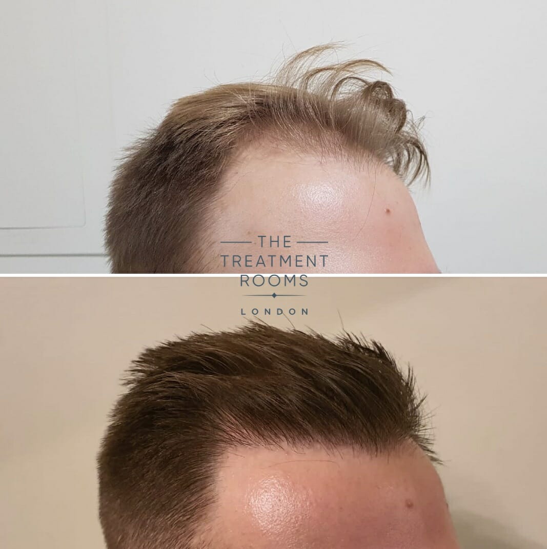 Receding hairline hair transplant before and after Receding hairline hair transplant before and after