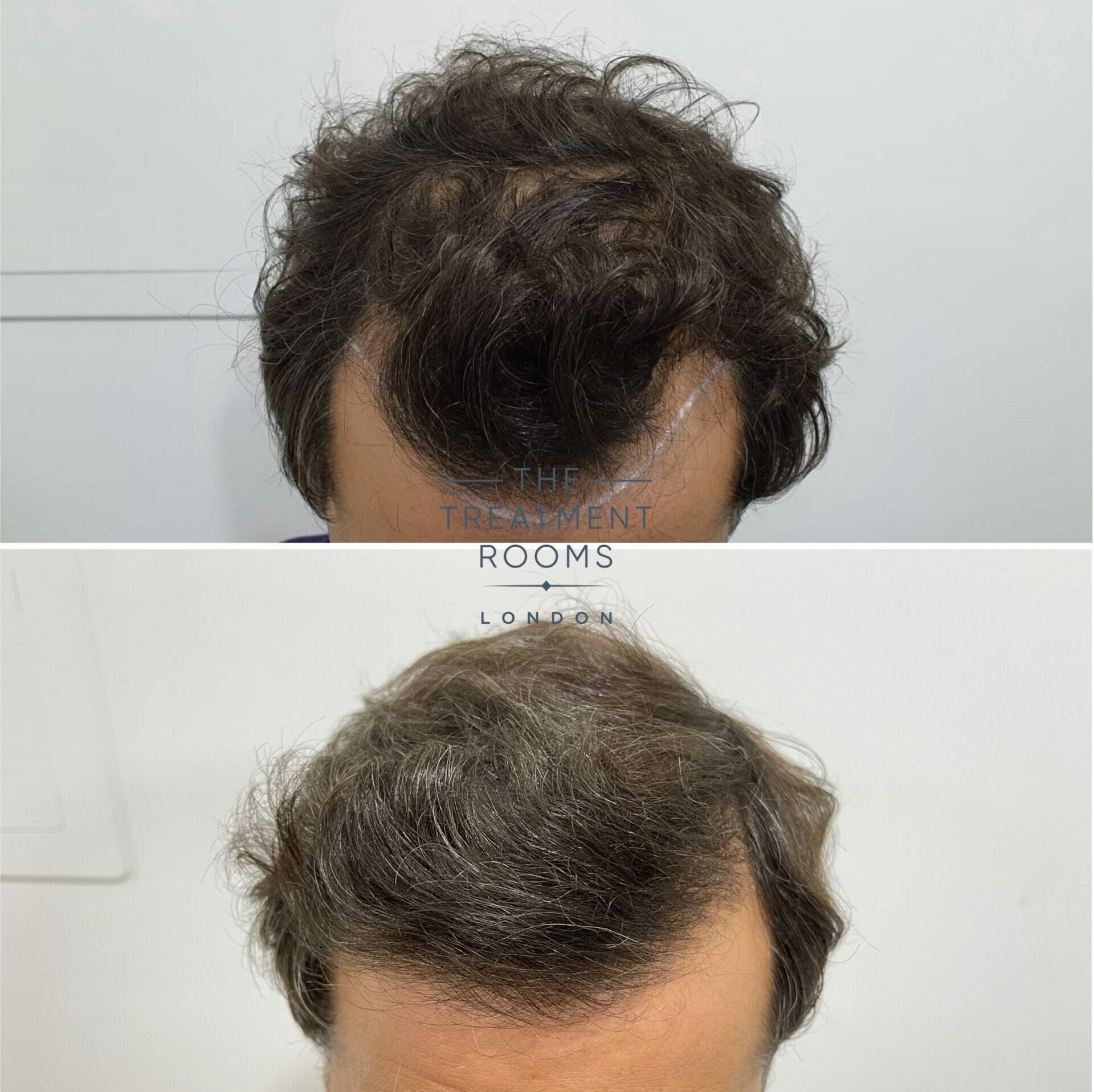 Receding hairline hair transplant result