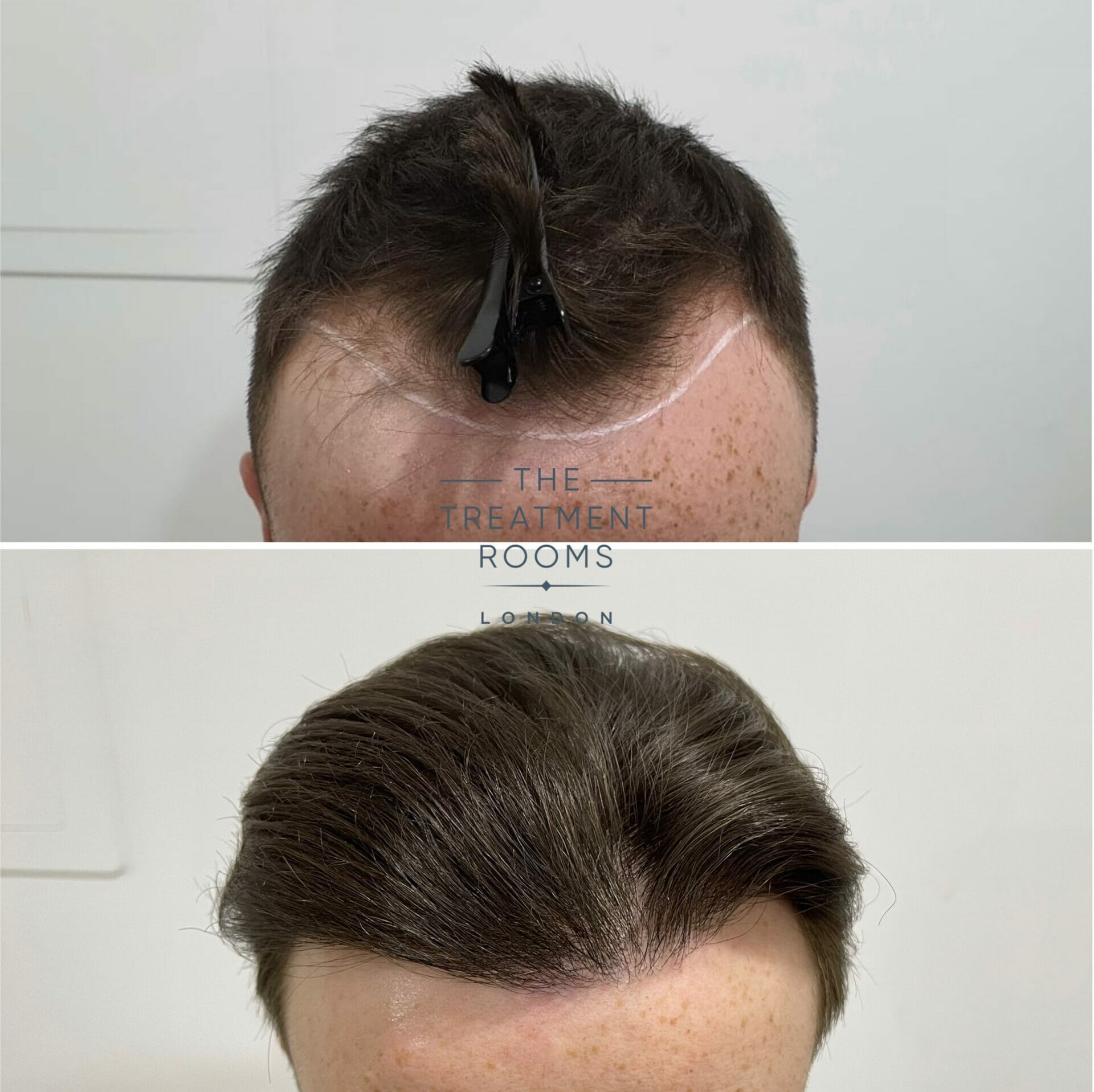 Receding hairline transplant